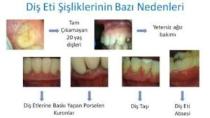 20’lik Diş Eti Şişmesi: Nedenleri ve Çözümleri
