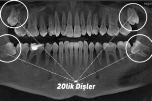 20’lik Diş İltihabı Belirtileri: Dikkat Edilmesi Gerekenler