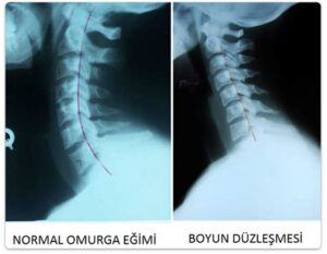 Boyun Fıtık Patlaması Belirtileri: Herkesin Bilmesi Gerekenler