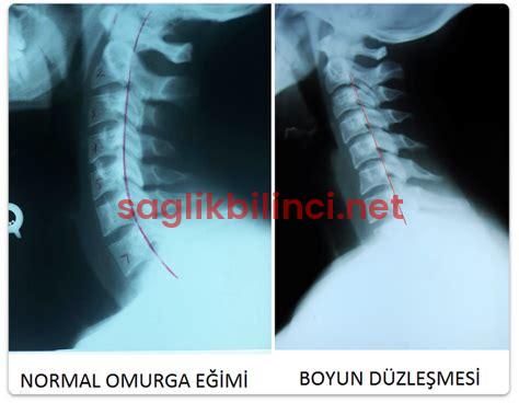 Boyun Fıtık Patlaması Belirtileri: Herkesin Bilmesi Gerekenler