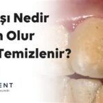 Diş Taşı Neden Olur? Belirtileri ve Önlenmesi