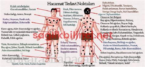 Hacamat Noktaları: Geleneksel Tedavi Yöntemleri ve Faydaları