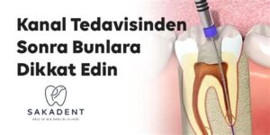 Kanal Tedavisi Sonrası: Dikkat Edilmesi Gerekenler