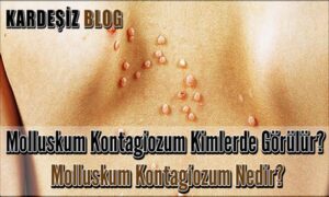 Molluskum Kontagiozum: Belirtileri ve Tedavi Yöntemleri