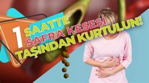Safra Kesesi Ameliyatı Olanların Deneyimleri ve Yorumları